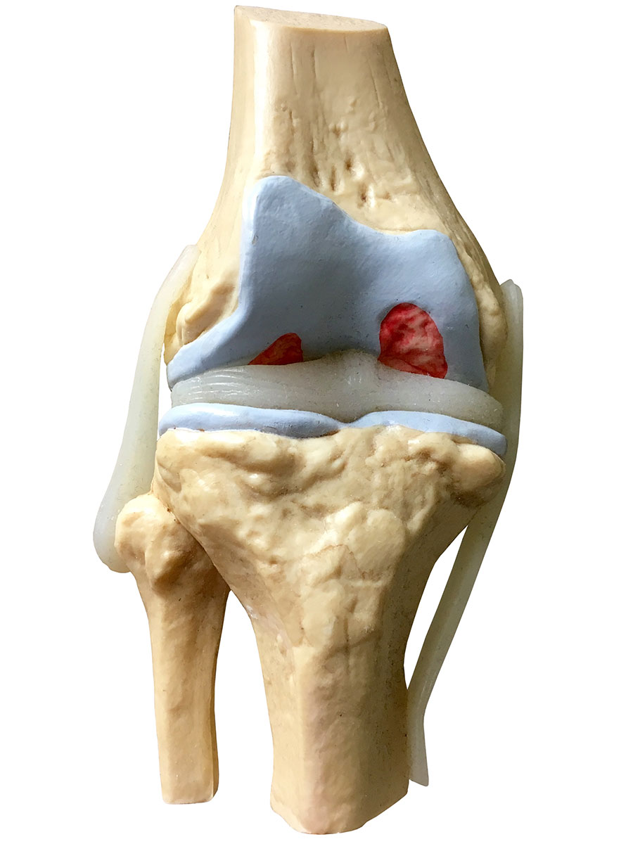 Does knee replacement surgery require specific rehabilitation afterward?