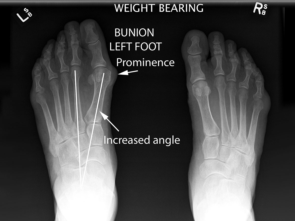 Mackie Orthopaedics | Common Foot Conditions